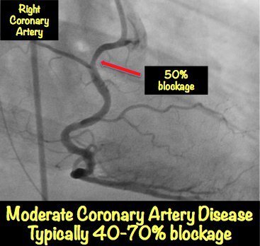 What are some treatments for blockage of the left anterior descending artery?
