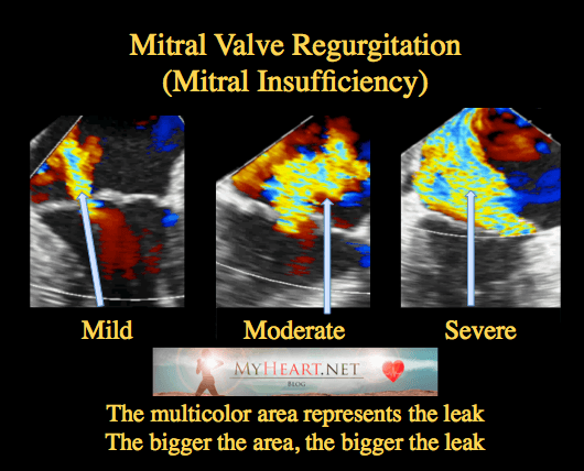 mitral-valve-moderate-mitral-valve-regurgitation