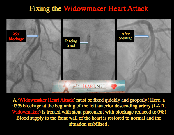 The Widowmaker Part II -Heart Hanging by a String