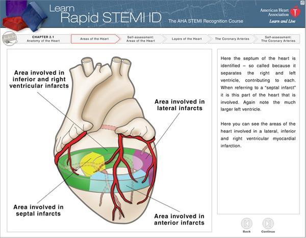 chapter-2-inferior-wall-myocardial-infarction-thoracic-key