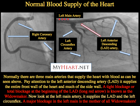 What are some treatments for blockage of the left anterior descending artery?