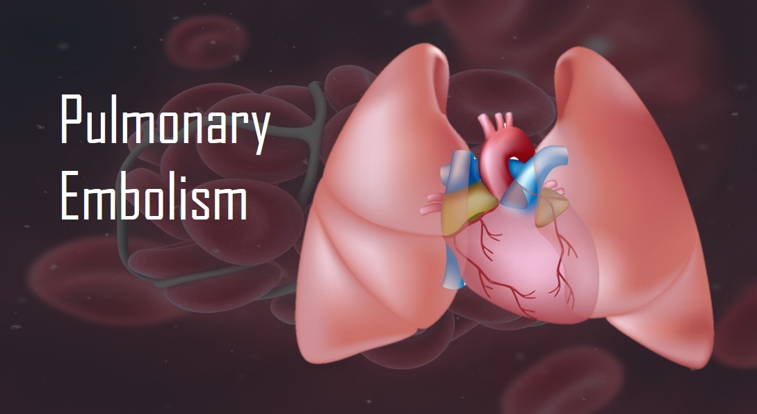 What is an embolism?