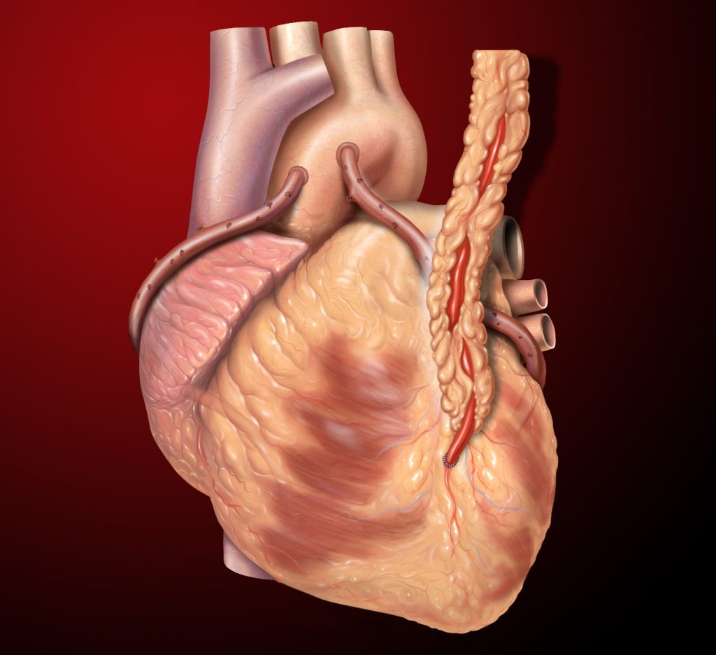 Heart Bypass Surgery Explained In Incredible Pictures • MyHeart