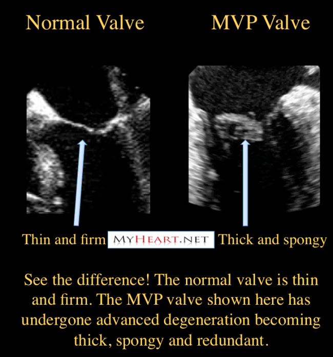 mitral valve prolapse