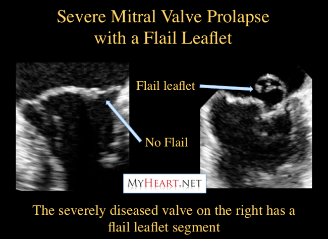 Flail leaflet in mitral valve prolapse