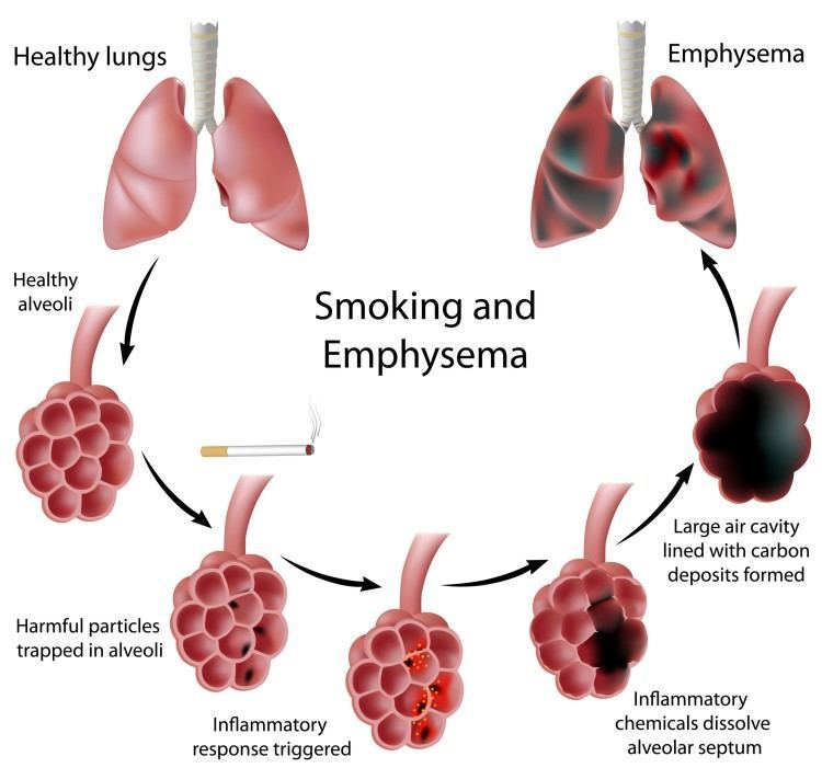 pneumonia 3 nursing diagnosis for Is What Overview COPD COPD? of MyHeart An