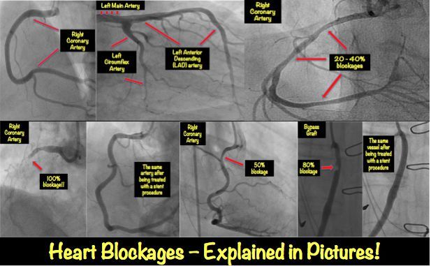 Heart Blockage – Explained With Pictures