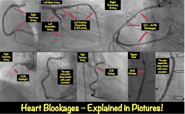 Heart Blockage Explained with Pictures MyHeart