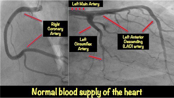 Left Anterior Descending Artery Blockage