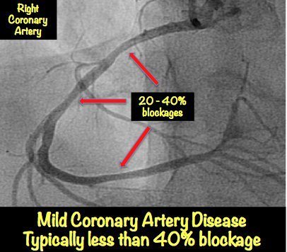 Mild Heart Blockage