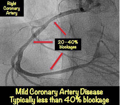 of heart blockage test Pictures Heart with Blockage: â€¢ MyHeart Explained