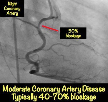 determine to test heart blockage MyHeart â€¢ Pictures Explained Heart with Blockage: