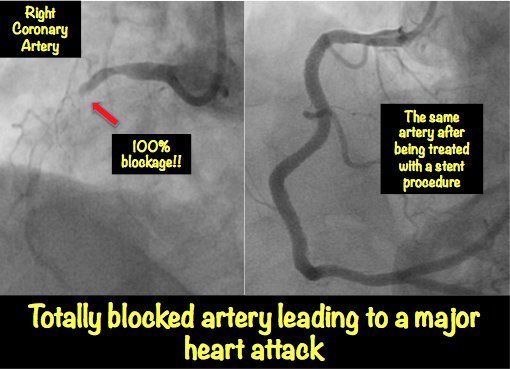 diagram heart test Heart MyHeart Pictures Blockage: â€¢ Explained with