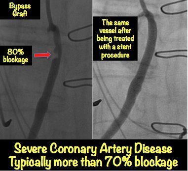 of heart test blockage MyHeart Blockage: Pictures with â€¢ Explained Heart