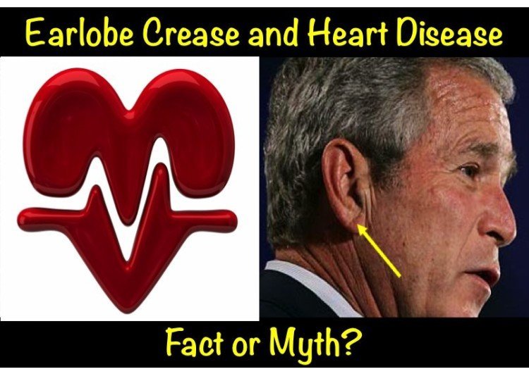 Earlobe Crease Heart Disease Fact Or