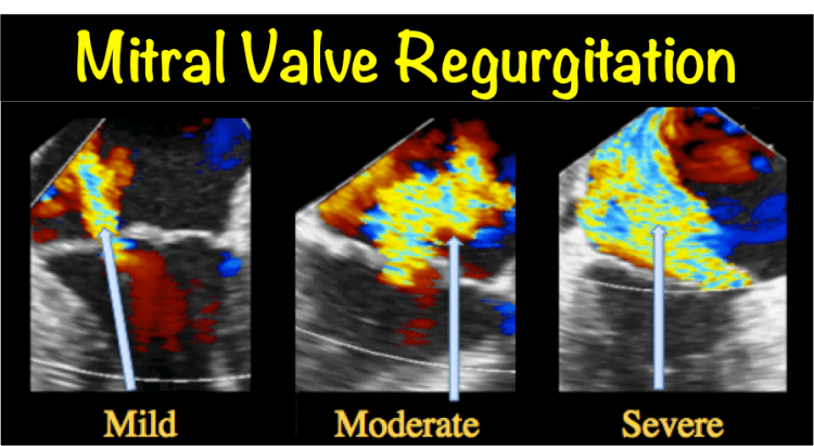 Hypokinesis, Mitral Regurgitation, Aortic Insufficiency 