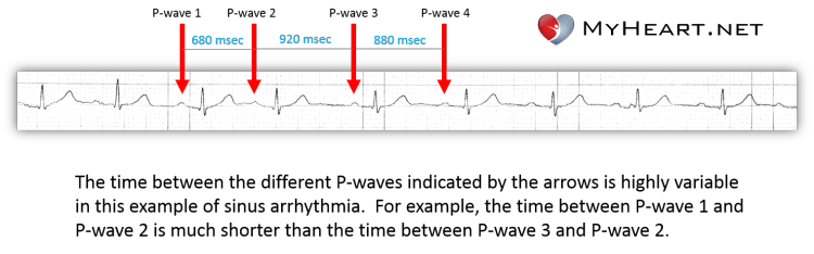 sinus arrhythmia rhythm strip