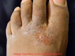 dry itchy skin on bottom of feet