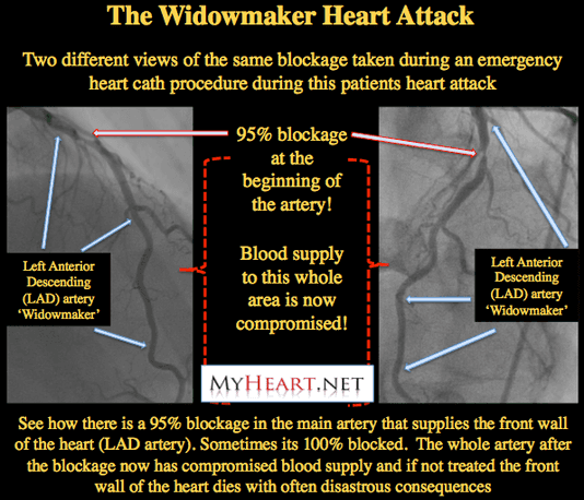 Heart Blockage: Explained with Pictures • MyHeart