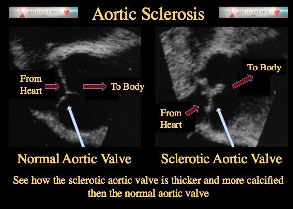 Aortic Sclerosis Diagnosis Treatments Risk Factors