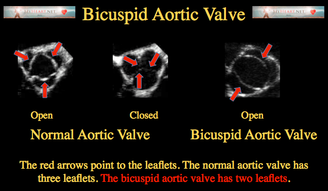 aortic valve echo