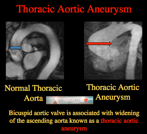 Bicuspid Aortic Valve Symptoms, Diagnosis, & Treatment