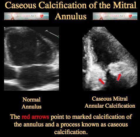 Caseous Calcification of the Mitral Annulus