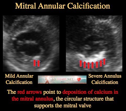 Mitral Annular Calcification