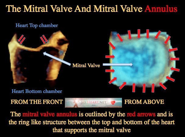 Mitral Annulus