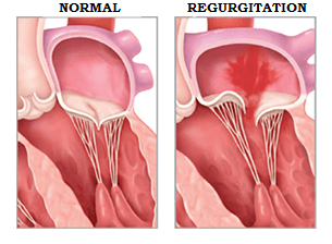 Mitral Regurgitation Explained myheart