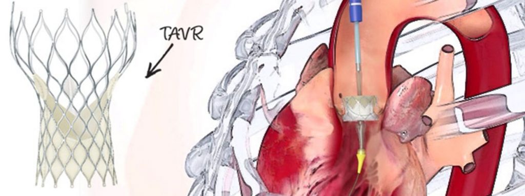 TAVR - FAQ's Answered By A Cardiologist - Myheart.net