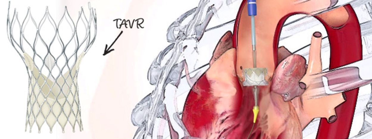 How Long To Recover From Tavr Surgery