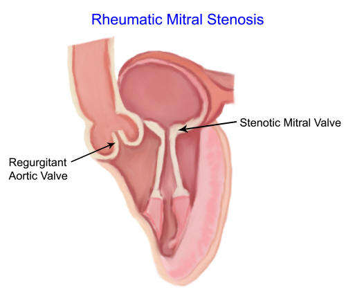 rheumatic-heart-disease-strep-throat-heart-disease