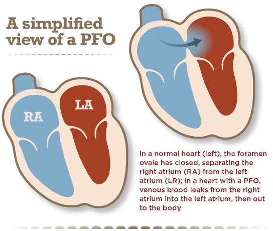 A blood clot formed in the exact shape of a man's lung passage - then he  coughed it up