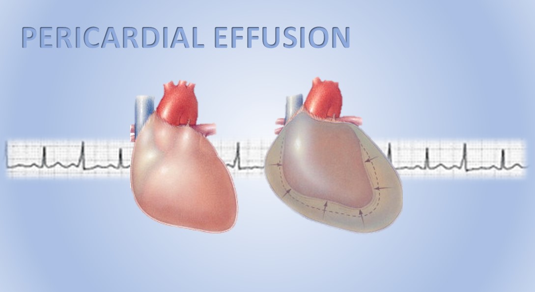 what causes fluid around the heart in dogs