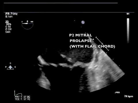 Mitral Valve Prolapse with Flail Chord