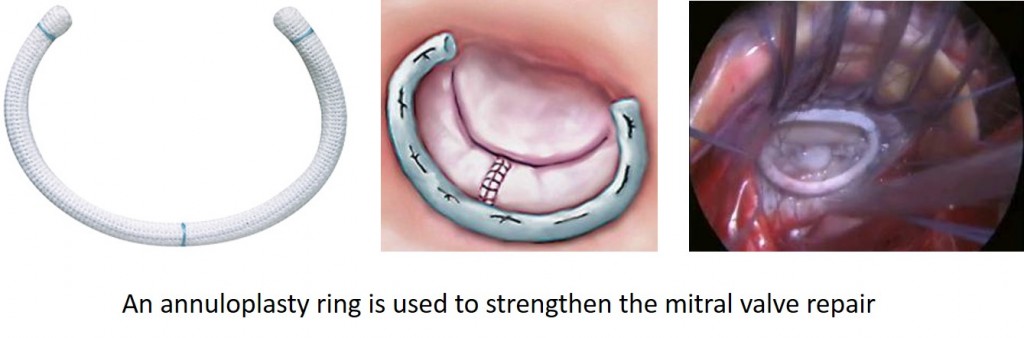 annuloplasty-ring