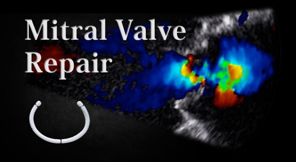 After Effects Of Mitral Valve Repair Surgery