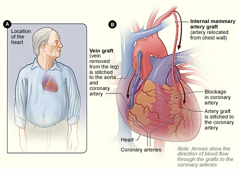 The I'm Back Recovery Shirt Empowers Heart Surgery Patients!