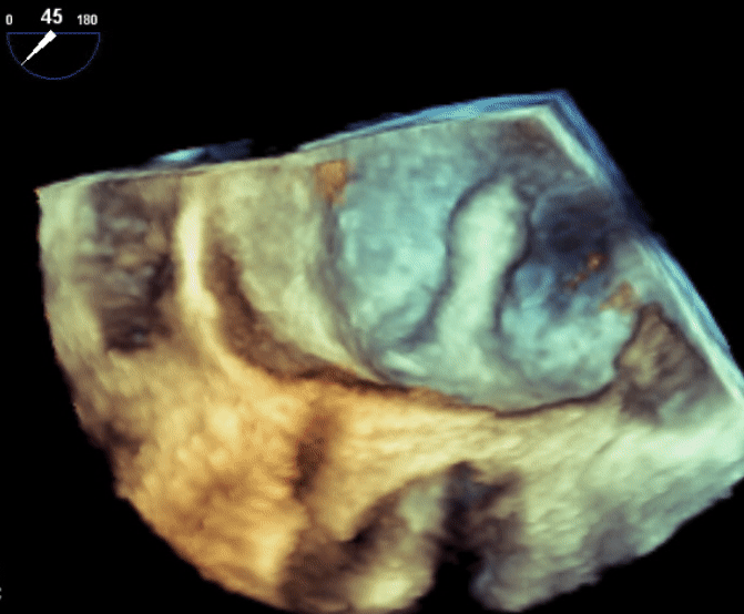 Echo Image 9. Delivery Catheter Crossing Septum in 3D live real time 3D images can be acquired to see sheath positioning. In this image the sheath can clearly be seen crossing the septum and in the left atrium. It can be seen heading towards the left atrial appendage / left upper pulmonary vein region.