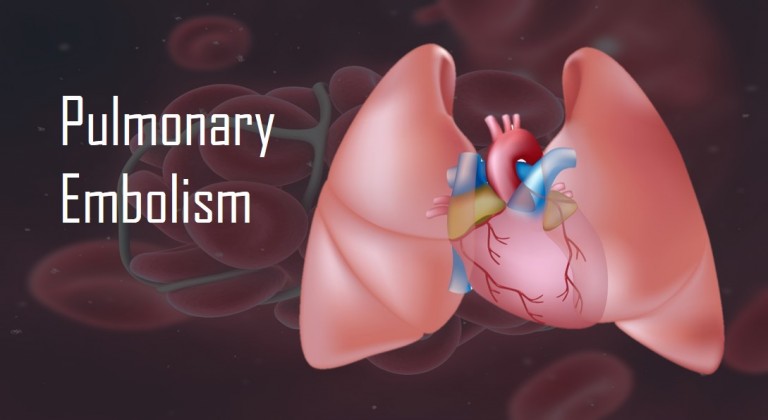 Pulmonary Embolism - The Killer Clot in the Lungs • MyHeart