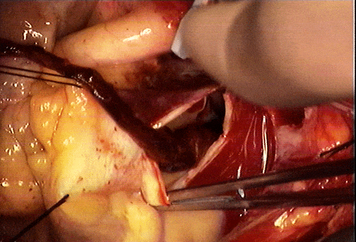 surgical extraction of pulmonary embolism