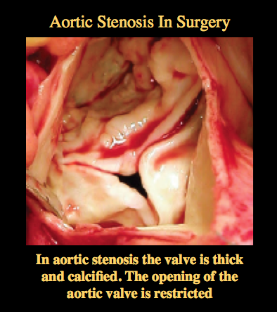aortic stenosis a tight aortic valve in surgery