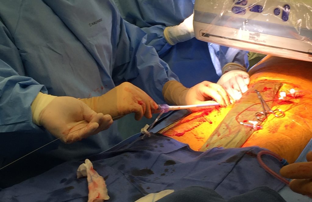 Sheath passed in to body. The sheath is the tube through which the TAVR valve is passed in to the body. We already placed a wire in to the vessel. Here we are passing the sheath over the wire in to the body.