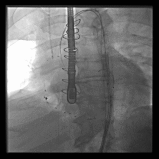 TAVR valve passed around aortic arch. The valve is passed from the leg up to the top of the aorta then around the arch of the aorta to the valve as demonstrated.