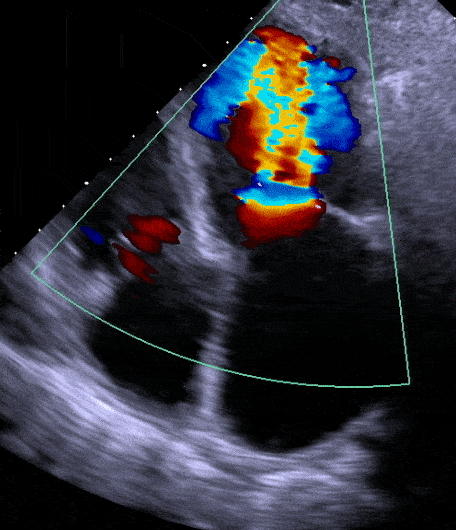 echocardiogram heart scan