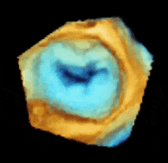 3D image of the mitral valve demonstrates a restricted valve opening.
