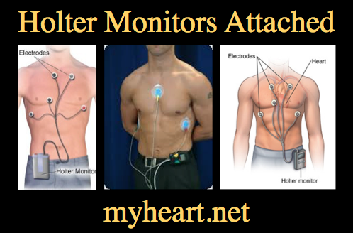 How to prepare for an ECG holter?