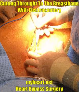 Heart Bypass Cutting To Breastbone With Electrocautery