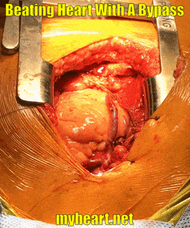 open heart surgery beating heart with a bypass